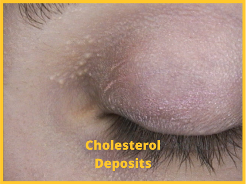 Cholesterol-Deposits-500x375-