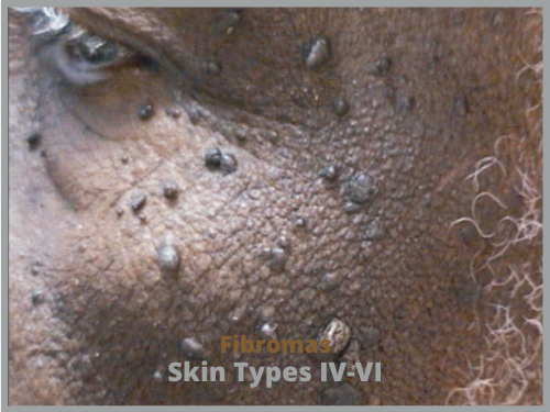 Fibromas-Skin-Types-IV-VI-500x375-