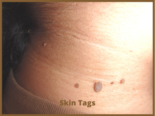 Skin-Tags-3-Brown-Rectangle-500x375-